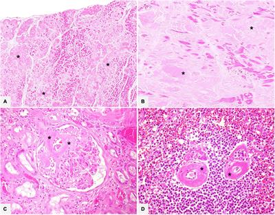 Amyloidosis: What does pathology offer? The evolving field of tissue biopsy